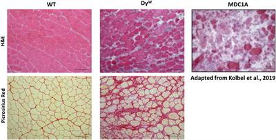 Fibrogenesis in LAMA2-Related Muscular Dystrophy Is a Central Tenet of Disease Etiology